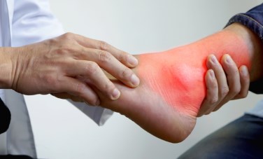 تجنب نوبات النقرس