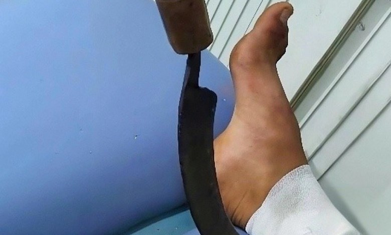 اصابة بمنجل 